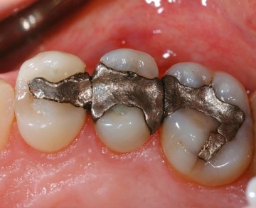 mercury filling removal are mercury fillings bad
