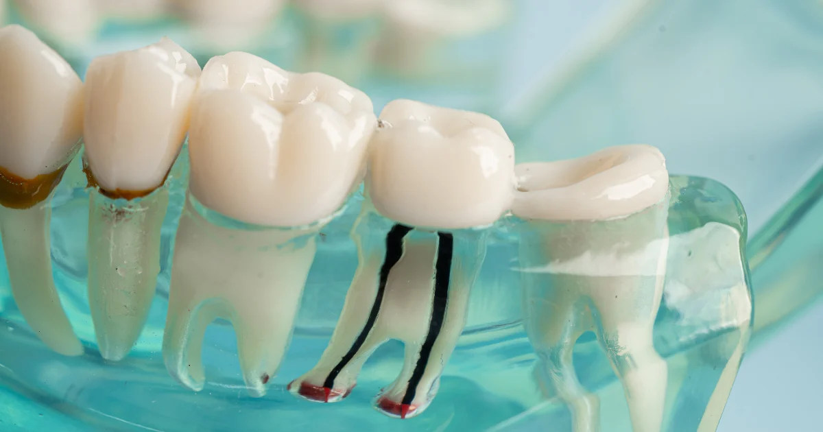 5 Qualities for Philadelphia Root Canal Dentists