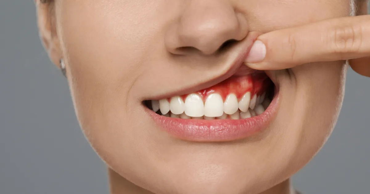 Guide to Treatment for Gum Recession Guide to Treatment for Gum Recession