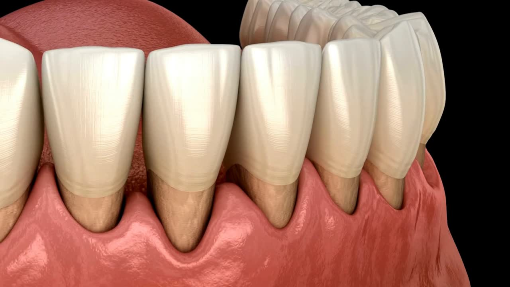 Gum Recession. Thumbnail