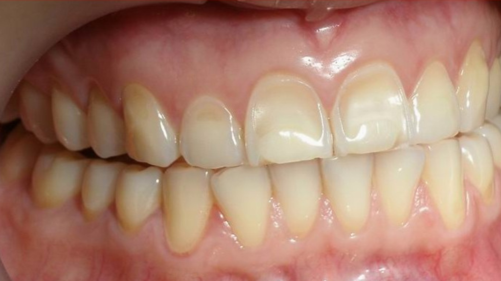 Stomach Acid Reflux and Teeth Erosion. Thumbnail