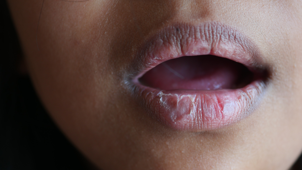 Dry Mouth (Xerostomia) Causes, Risks, and How to Treat It