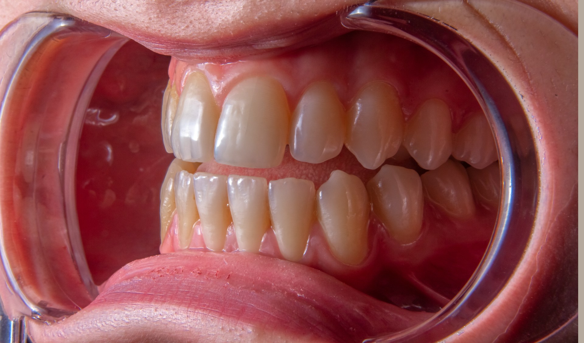 Dental Plaque What It Is and How to Protect Your Smile Naturally (2)